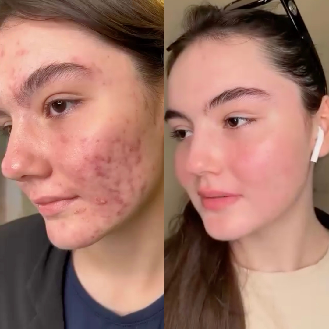 Lucenova – Die LED-Therapiemaske für strahlende Haut