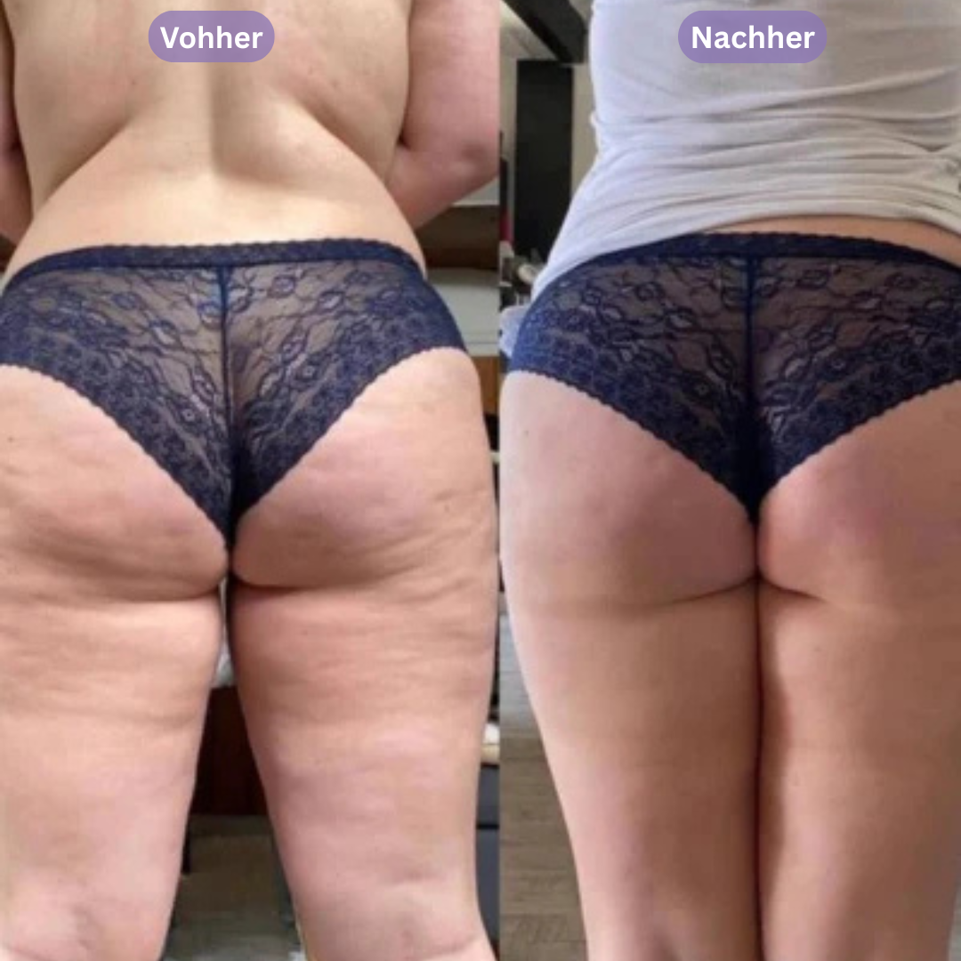 SIKIFY – Schröpfen für glattere Haut